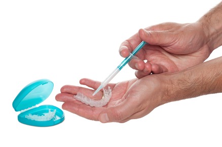 SBIANCAMENTO DENTALE – Quello che dovresti sapere